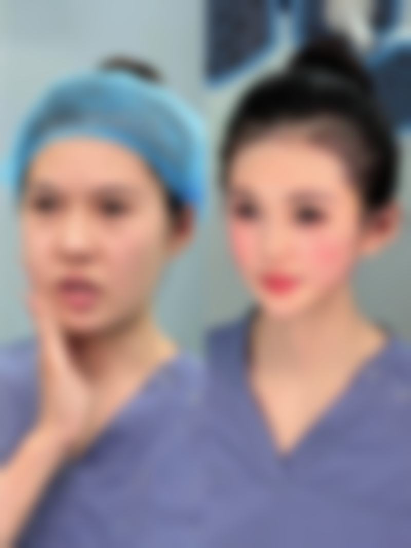 四、做完双眼皮忌口的时长