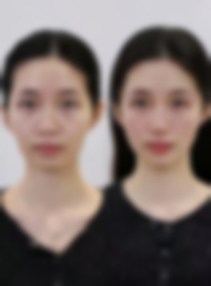 四、西安雍禾植发特色项目