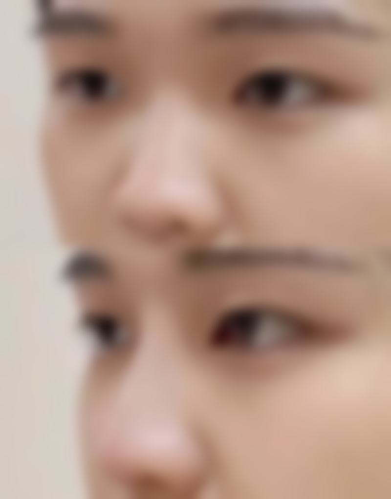一、割双眼皮有什么禁忌之术前人群限制