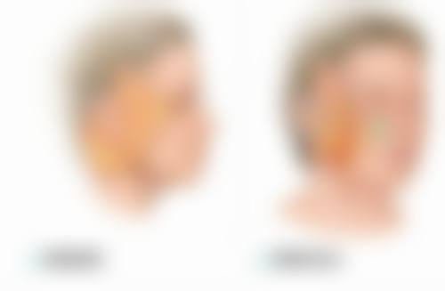 五、冷冻液氮治疗疤痕疙瘩的注意事项
